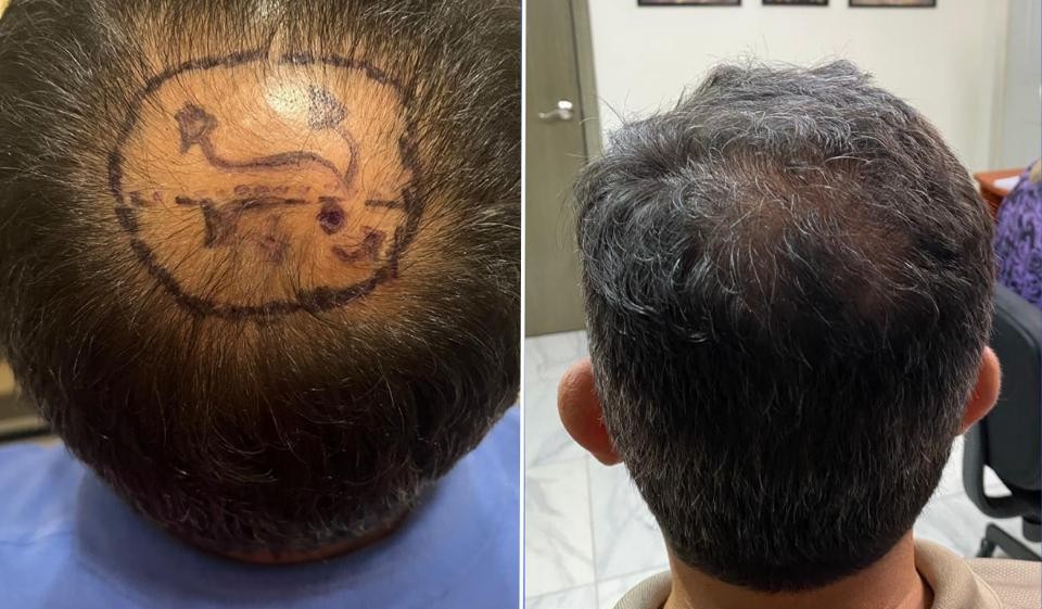 Caso de injerto en coronilla, antes y después