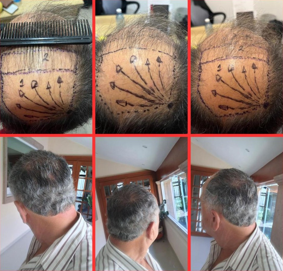 Caso de injerto en coronilla, antes y después