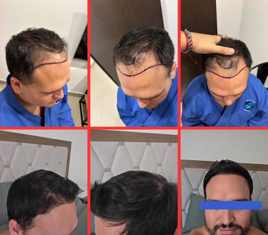 Caso de injerto en zona frontal, antes y después