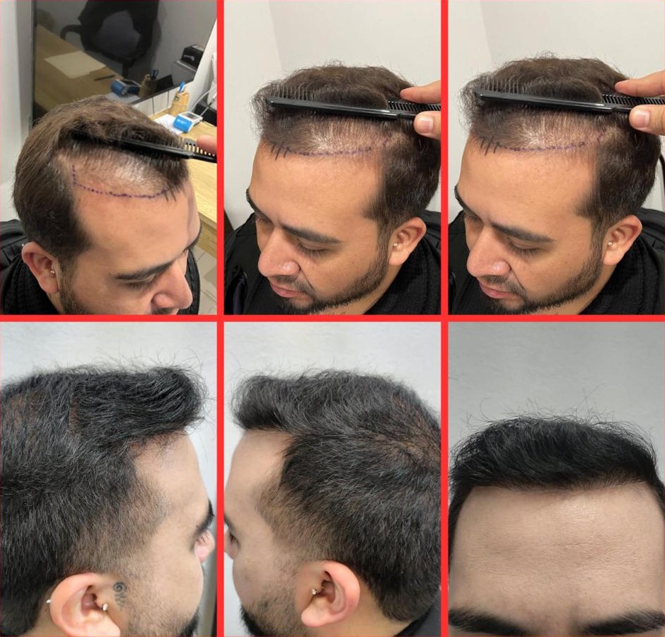 Caso de injerto en entradas, antes y después