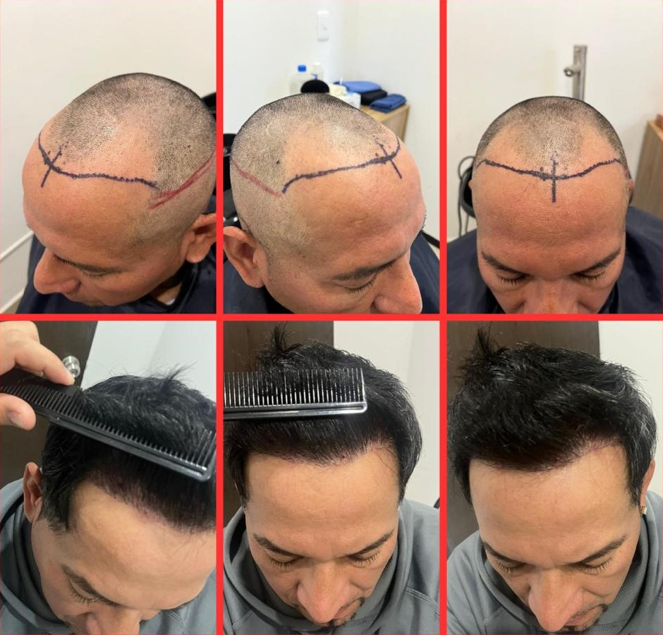 Caso de injerto en zona frontal, antes y después