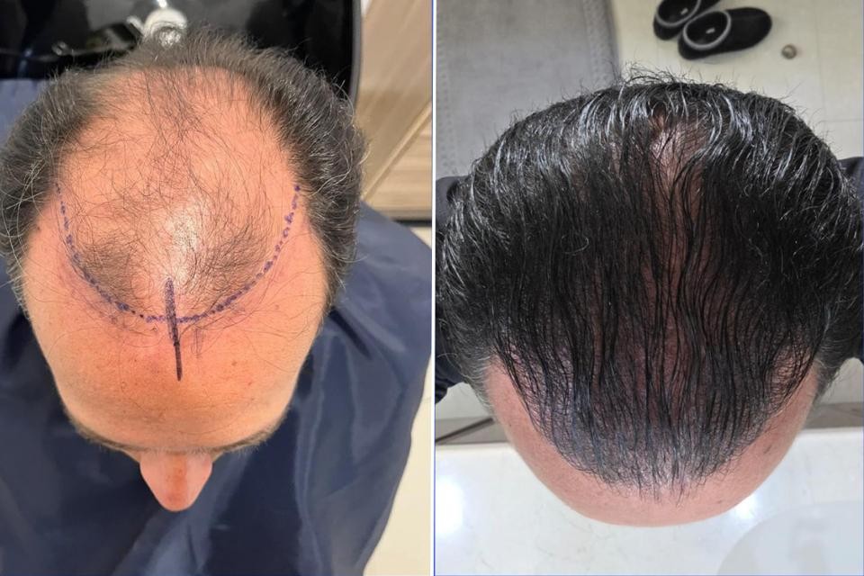 Caso de máxima extracción, antes y después